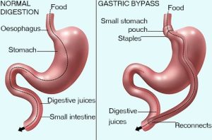 bariatric-surgery